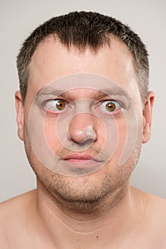 A man with strabismus squints his eyes on a white background.