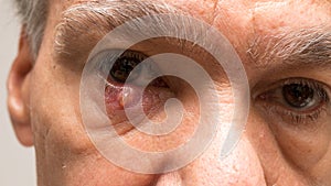 Man with stye on eyelid