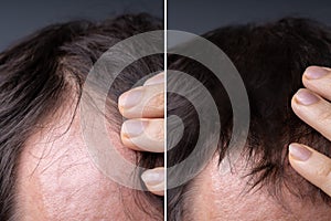 Man Before And After Hair Loss Treatment