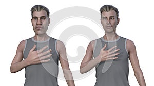A man suffering from acromegaly, 3D illustration