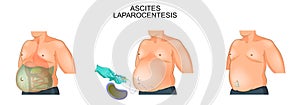 A man suffering from ascites. Laparocentesis