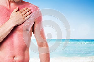 Man with a sunburn