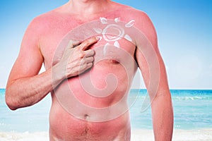 Man with a sunburn photo