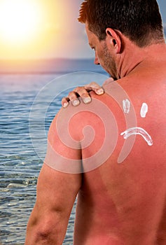 Man with sunburned skin