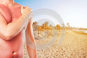 Man with sunburned skin from the sun on the beach photo