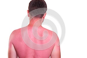 Man with sunburnt back on white background