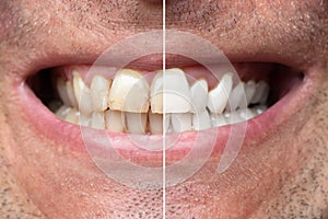 Man Teeth Before And After Whitening