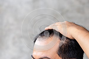 Man touching his head to show bald head or Glabrous problem. Copy space with grey background