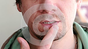 Man touching sores on the lips. Herpes. Lip treatment. Close-up of the man`s lips with herpes. Front view.