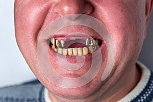 A man without upper front teeth. Inserting teeth
