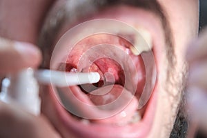 Man using a spray to treat an aphthae or sore on his throat. photo