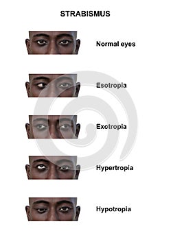 A man with various strabismus types, 3D illustration