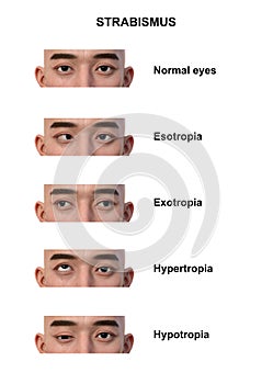 A man with various strabismus types, 3D illustration photo