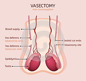 Man vasectomy image