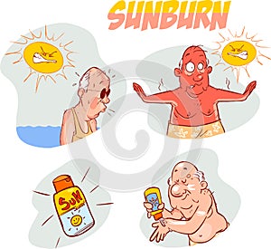 Man with a very bad sunburn