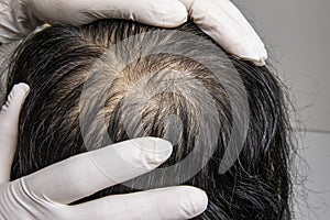 Man visit dermatologist for his hair fall problem.