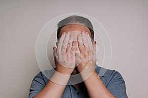 Man with Vitiligo hiding face photo
