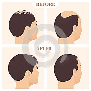 Man and woman in side view before and after hair loss treatment