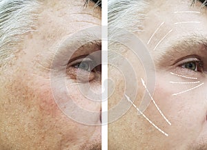 Man, wrinkles on face before and after aging dermatology therapy procedures