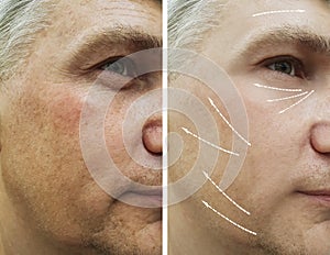 Man, wrinkles on face before and after dermatology therapy procedures