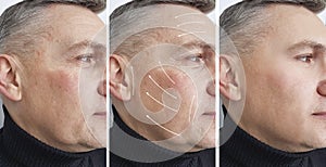 Man wrinkles on the face before and after dermatology removal procedures, arrow
