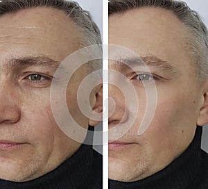 Man wrinkles face before and after procedures correction cosmetic procedures