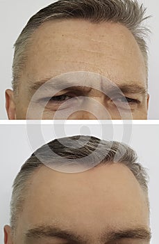 Man wrinkles on the forehead before and after botox