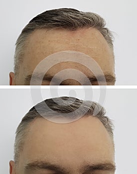 Man wrinkles on the forehead before and after