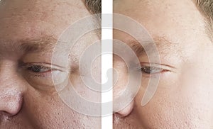 Man wrinkles before and after the procedure bloating