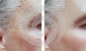 Man wrinkles before and after procedures, acne pigmentation