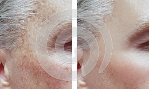 Muž vrásky před a po postupy akné pigmentace 