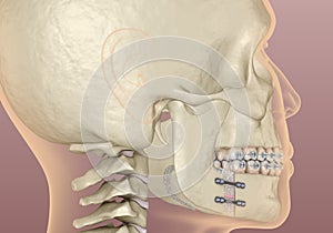 Mandibular Advancement surgery. Medically accurate dental 3D illustration