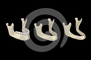 Mandibular Jaw, bone recession after losing teeth. Medically accurate dental 3D illustration