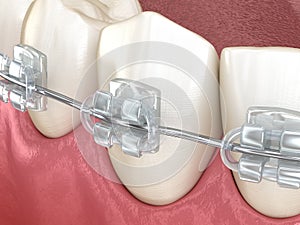 Mandibular jaw and Clear braces. Medically accurate dental 3D illustration