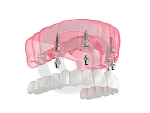 Mandibular prosthesis all on 4 system supported by implants