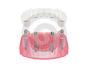 Mandibular prosthesis all on 4 system supported by implants