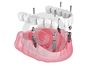 Mandibular prosthesis all on 4 system supported by implants