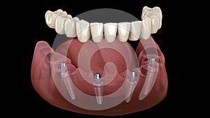 Mandibular prosthesis All on 4 system supported by implants. Medically accurate 3D animation of human teeth and dentures concept