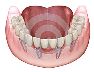 Mandibular prosthesis All on 4 system supported by implants. Medically accurate 3D illustration of human teeth