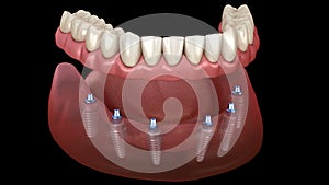 Mandibular prosthesis All on 6 system supported by implants