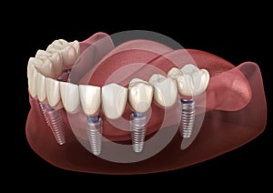 Mandibular prosthesis All on 6 system supported by implants. Medically accurate 3D illustration of human teeth