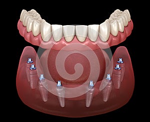 Mandibular prosthesis All on 8 system supported by implants. Medically accurate 3D illustration of human teeth