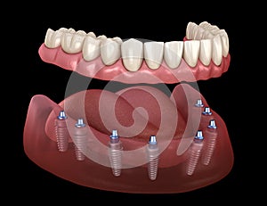 Mandibular prosthesis All on 8 system supported by implants. Medically accurate 3D illustration of human teeth and dentures
