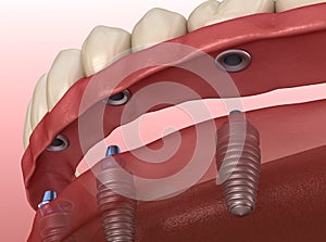 Mandibular prosthesis with gum All on 6 system supported by implants.