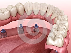 Mandibular prosthesis with gum All on 6 system supported by implants.  Medically accurate 3D illustration of human teeth