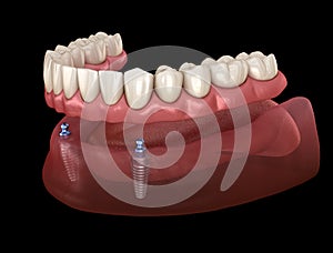 Mandibular removable prosthesis All on 2 system supported by implants with ball attachments. Medically accurate dental