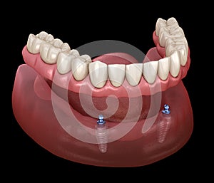 Mandibular removable prosthesis All on 2 system supported by implants with ball attachments. Medically accurate dental photo