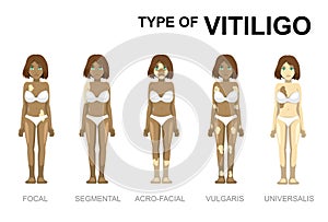 Manga Cartoon Type of Vitiligo Woman Set