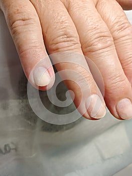 Manicure , onycholysis , gel