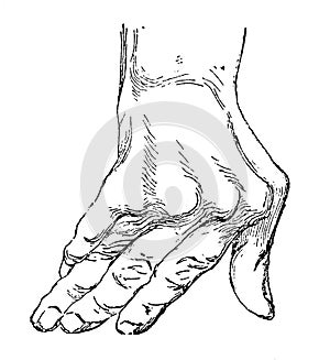 Manifestation of long-standing deforming arthritis on the fingers.